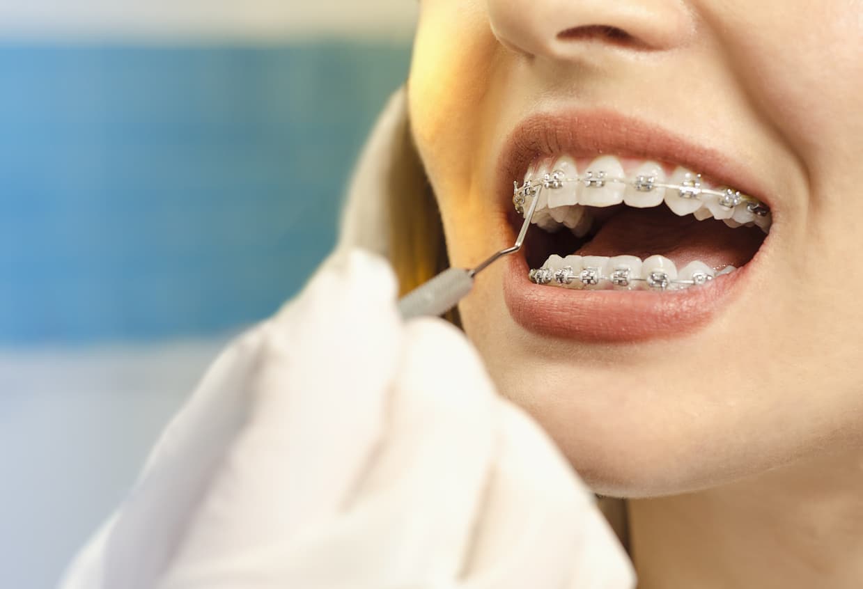 Close Up Of Braces.jpg