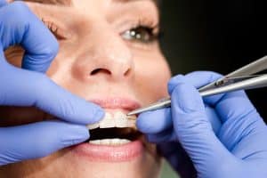 Can You Straighten Only Your Bottom Teeth with Braces? – Andover