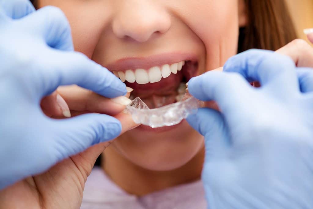 How Do You Clean Invisalign Retainers & Trays?
