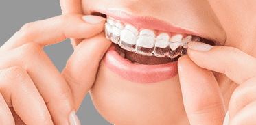 Invisalign Appliance