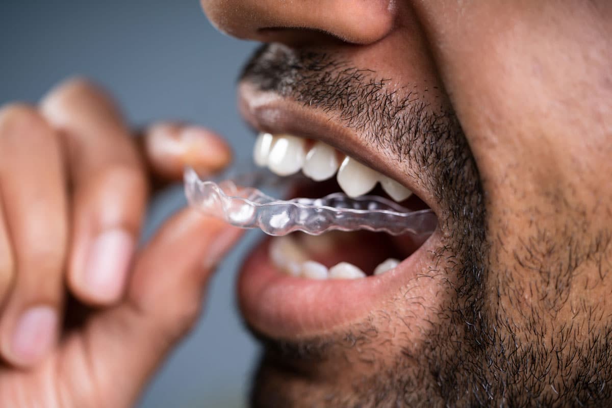 How Long Do You Have To Wear A Retainer After Your Braces Come Off?